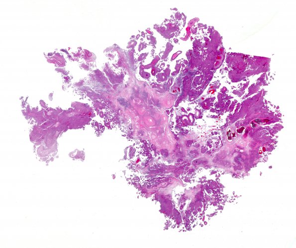 1B1 Meningioma, papillary (Case 1) H&E WM