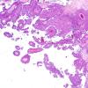 1B2 Meningioma, papillary (Case 1) H&E 1A