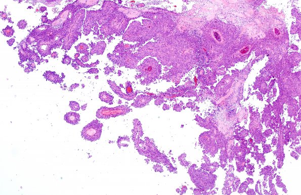 1B2 Meningioma, papillary (Case 1) H&E 1A