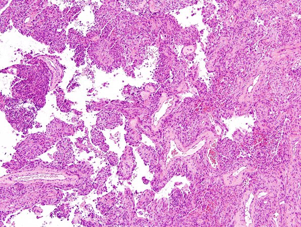 1B3 Meningioma, papillary (Case 1) C6 2.jpg