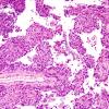 1B4 Meningioma, papillary (Case 1) C6 4.jpg