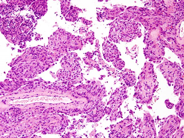 1B4 Meningioma, papillary (Case 1) C6 4.jpg