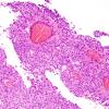 1B5 Meningioma, papillary (Case 1) H&E 4