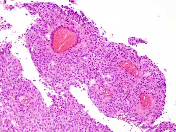 1B5 Meningioma, papillary (Case 1) H&E 4