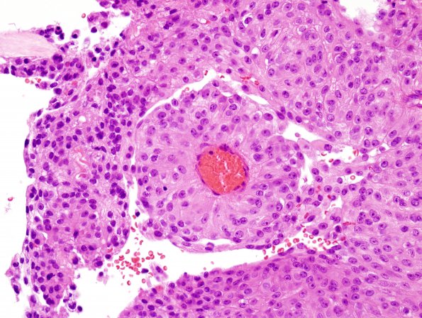 1B6 Meningioma, papillary (Case 1) H&E 6