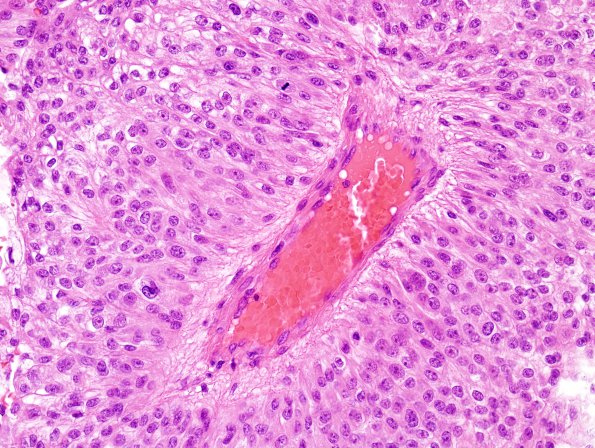 1B7 Meningioma, papillary (Case 1) H&E 8