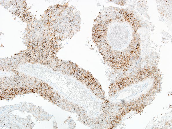 1C3 Meningioma, papillary (Case 1) EMA 4