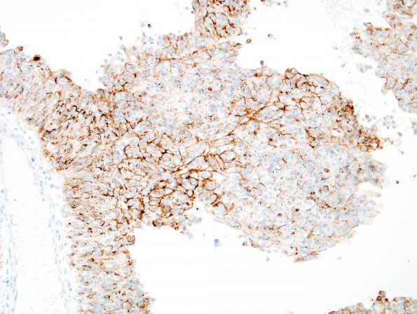 1C4 Meningioma, anaplastic, papillary (Case 1) EMA 6