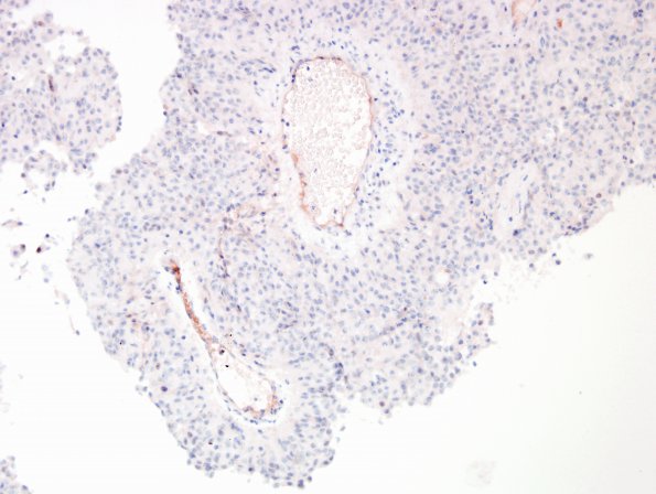 1D Meningioma, papillary (Case 1) PR 2