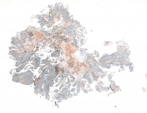 1E1 Meningioma, papillary (Case 1) MIB WM