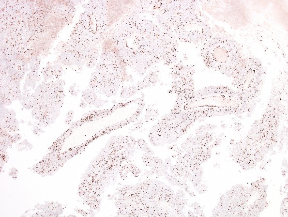 1E2 Meningioma, papillary (Case 1) MIB 5