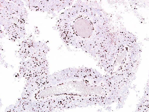 1E3 Meningioma, anaplastic, papillary (Case 1) MIB 4