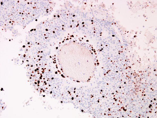 1E4 Meningioma, anaplastic, papillary (Case 1) MIB 2