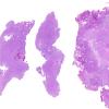 2A1 Meningioma, papillary (Case 2) H&E WM