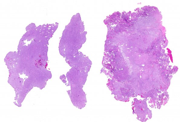 2A1 Meningioma, papillary (Case 2) H&E WM