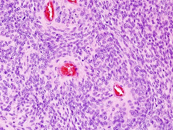 2A3 Meningioma, papillary (Case 2) H&E 7.jpg