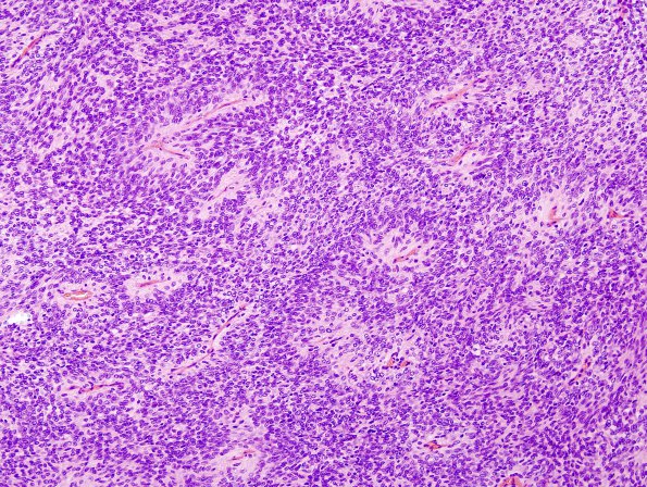 2A4 Meningioma, papillary (Case 2) H&E 1