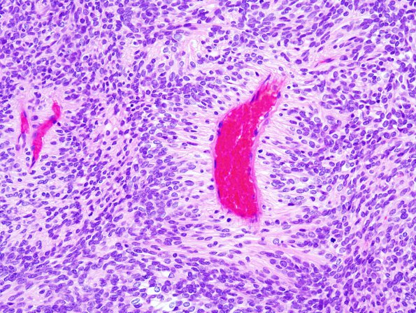 2A5 Meningioma, Papillary (Case 2) 3.jpg