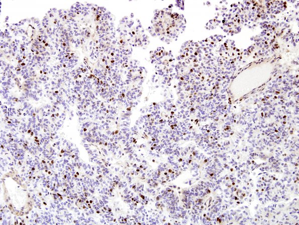 2C2 Meningioma, papillary (Case 2) Ki67 6.jpg