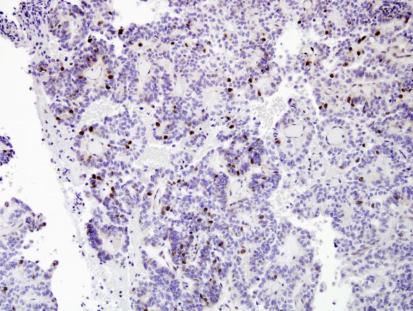 2C3 Meningioma, papillary (Case 2) Ki67 8.jpg