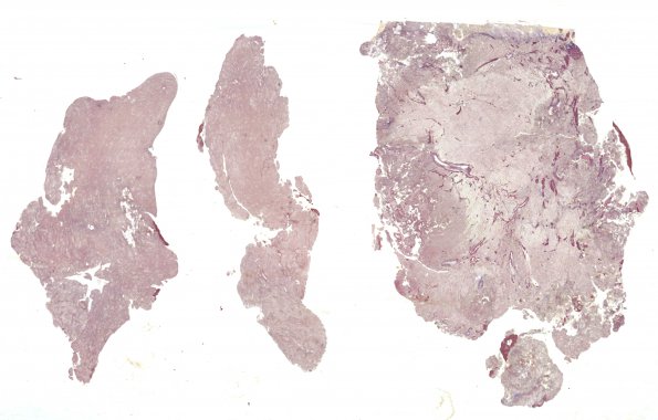 2D1 Meningioma, papillary (Case 2) Retic WM