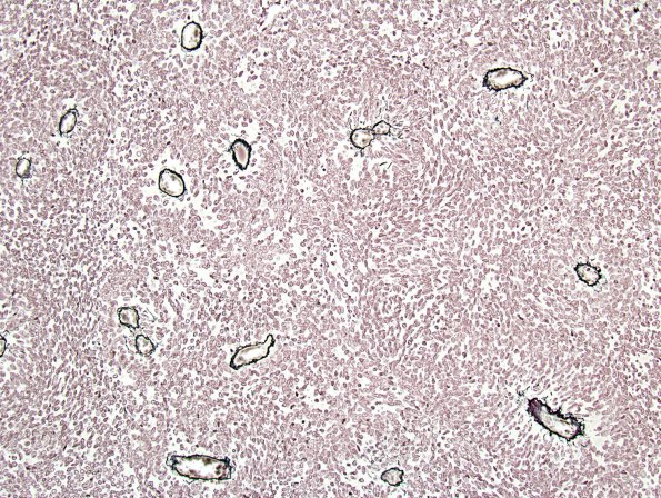 2D2 Meningioma, Papillary (Case 2) Retic 1.jpg