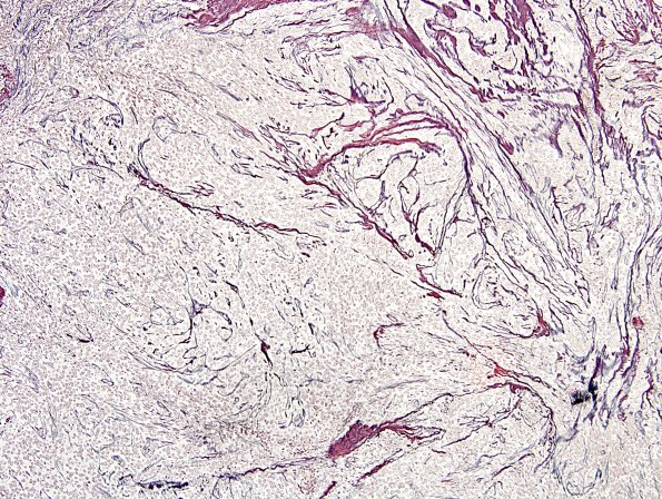 2D3 Meningioma, papillary (Case 2) Retic 2.jpg