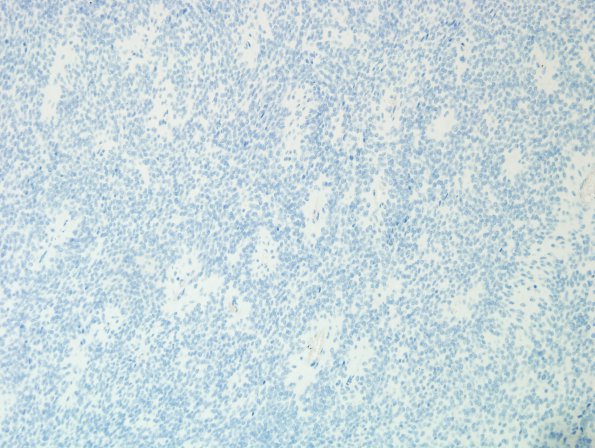 2E1 Meningioma, papillary (Case 2) GFAP 3 (2).jpg