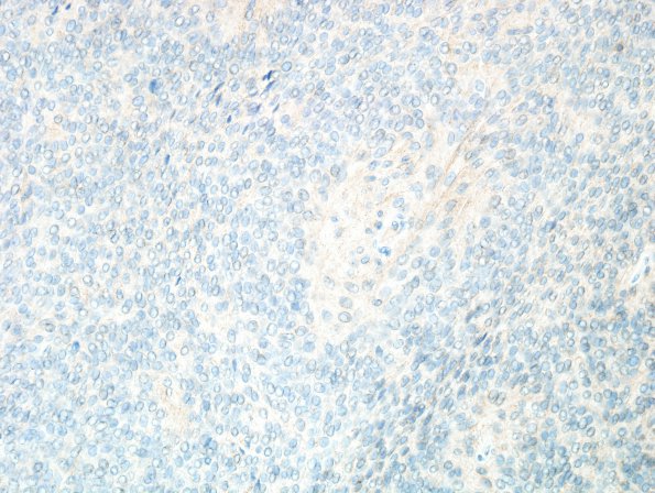 2F Meningioma, papillary (Case 2) CD99 1.jpg