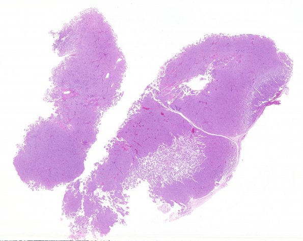 3A1 Meningioma, papillary & rhabdoid (Case 3) 1 H&E WM