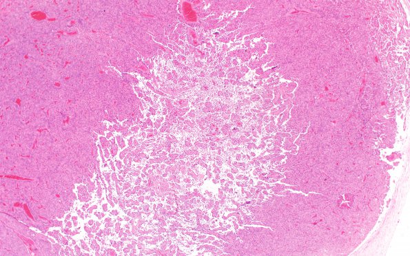 3A2 Meningioma, papillary & rhabdoid (Case 3) 1 H&E 2X