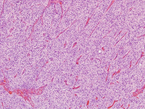 3A3 Meningioma, papillary & rhabdoid (Case 3) H&E 14.jpg