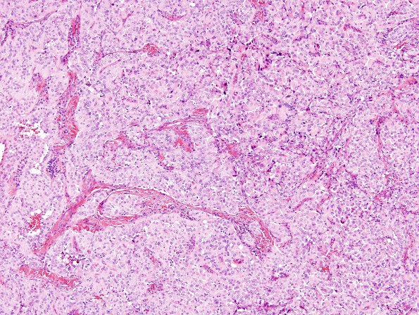 3A4 Meningioma, papillary & rhabdoid (Case 3) H&E 1.jpg