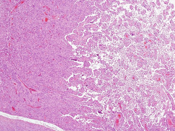 3A5 Meningioma, papillary & rhabdoid (Case 3) H&E 13.jpg