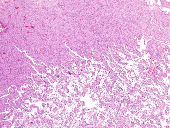 3A6 Meningioma, papillary & rhabdoid (Case 3) H&E 12.jpg