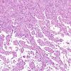 3A7 Meningioma, papillary & rhabdoid (Case 3) H&E 11.jpg