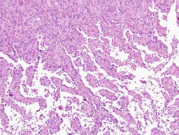 3A7 Meningioma, papillary & rhabdoid (Case 3) H&E 11.jpg