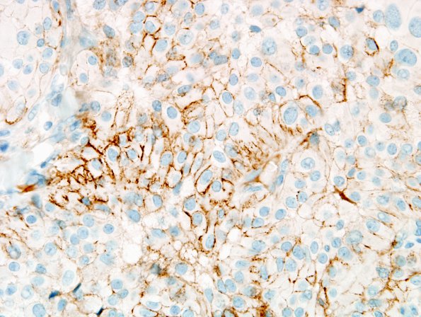 3B2 Meningioma, papillary & rhabdoid (Case 3) minimal EMA 1.jpg