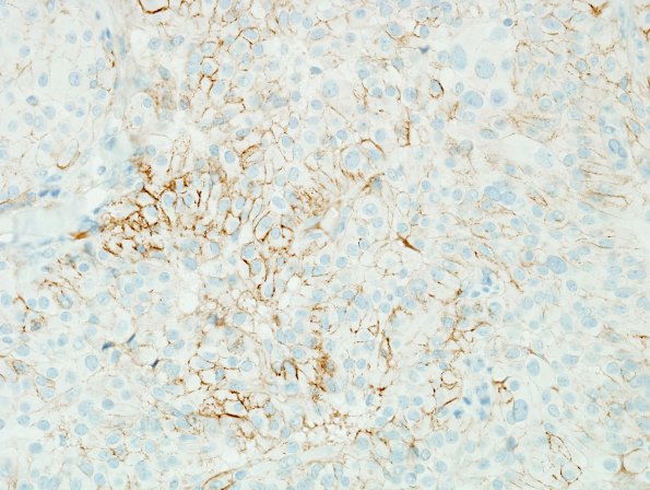 3B3 Meningioma, papillary & rhabdoid (Case 3) minimal EMA 5.jpg