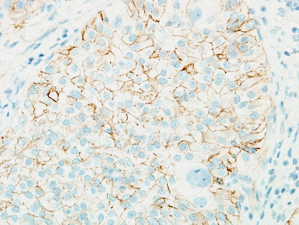 3B4 Meningioma, papillary & rhabdoid (Case 3) minimal EMA 6.jpg