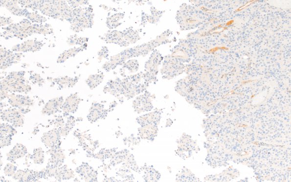 3C Meningioma, papillary & rhabdoid (Case 3) PR none 1