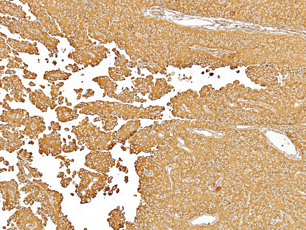 3D2 Meningioma, papillary & rhabdoid (Case 3) VIM 6.jpg