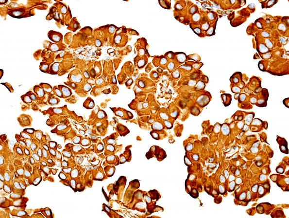 3D4 Meningioma, papillary & rhabdoid (Case 3) VIM 1.jpg