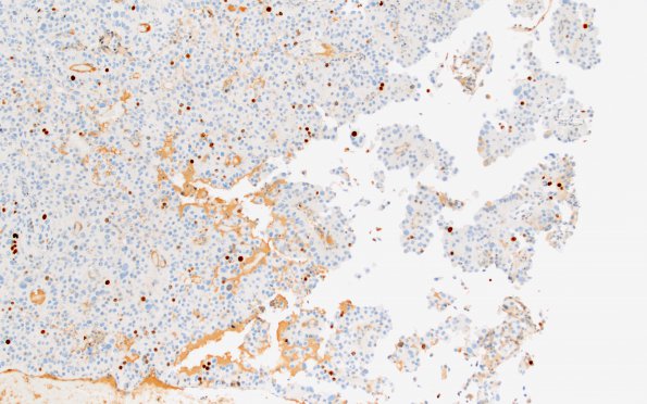 3E Meningioma, papillary & rhabdoid (Case 3) Ki67 3