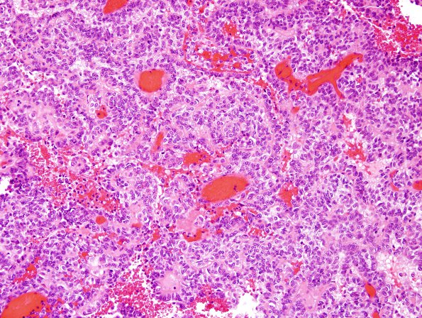 4A1 Meningioma, papillary (Case 4) H&E 1.jpg