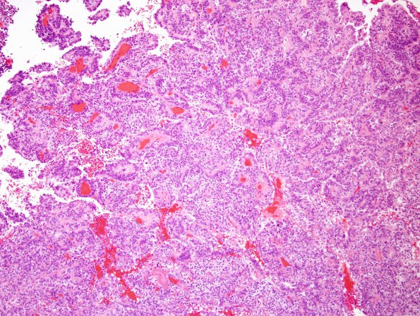 4A2 Meningioma, papillary (Case 4) H&E 2.jpg