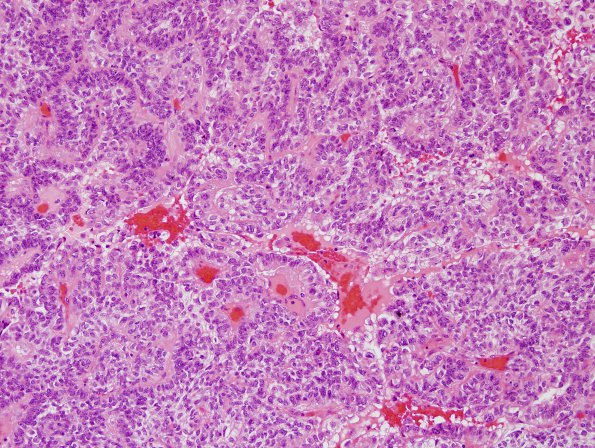 4A3 Meningioma, papillary (Case 4) H&E 4.jpg