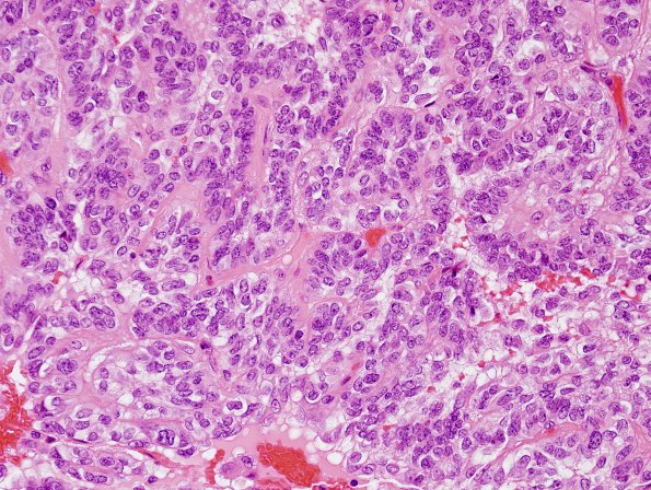 4A4 Meningioma, papillary (Case 4) H&E 5.jpg