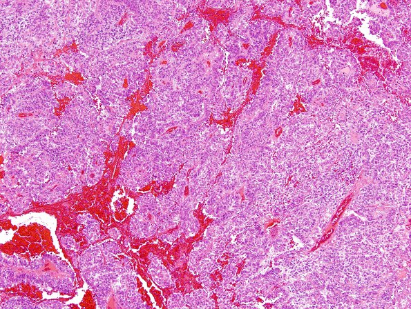 4A5 Meningioma, papillary (Case 4) H&E 6.jpg