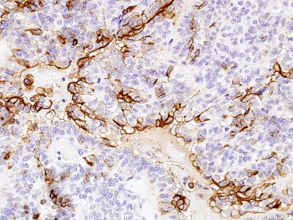 4B4 Meningioma, papillary (Case 4) EMA 9.jpg